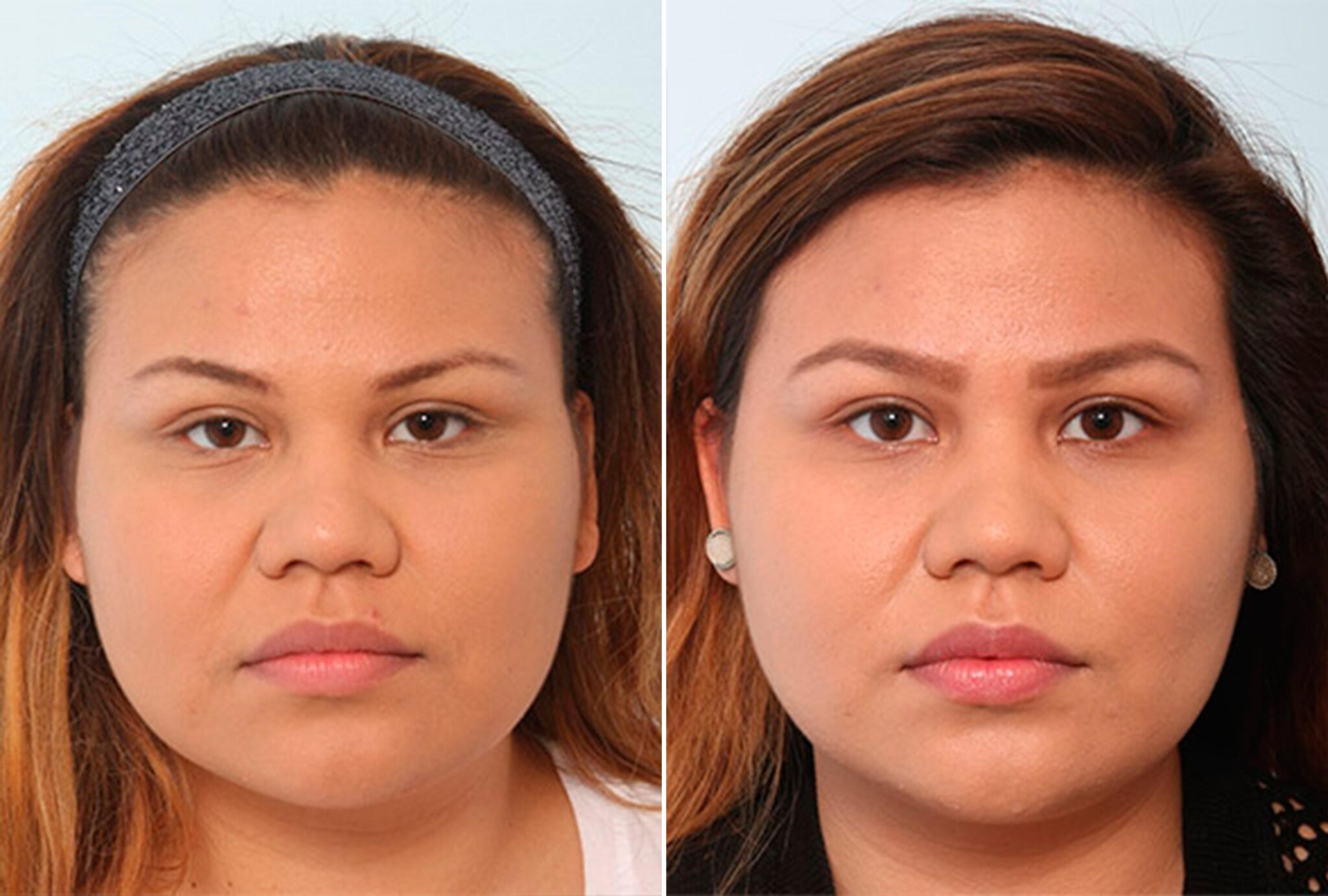 Buccal Fat Everything You Should Know About This Procedure 7181